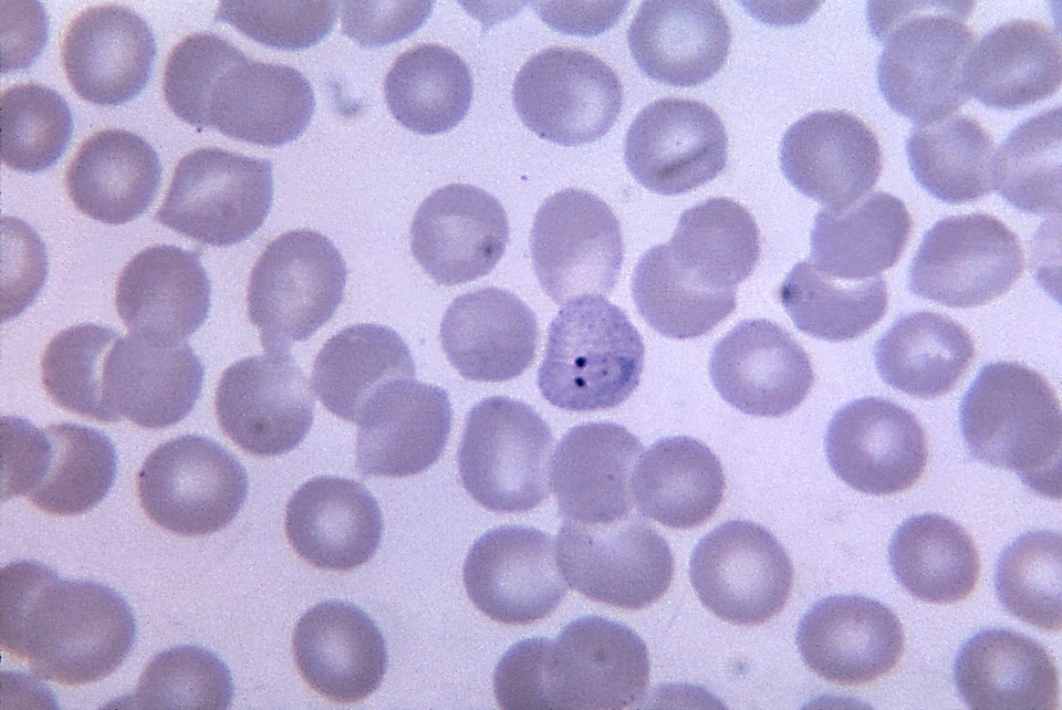 Blood cervical smear chromatin