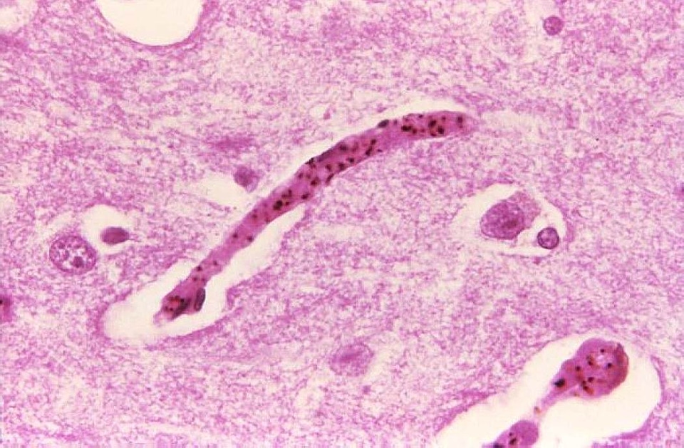 Brain histopathology malaria