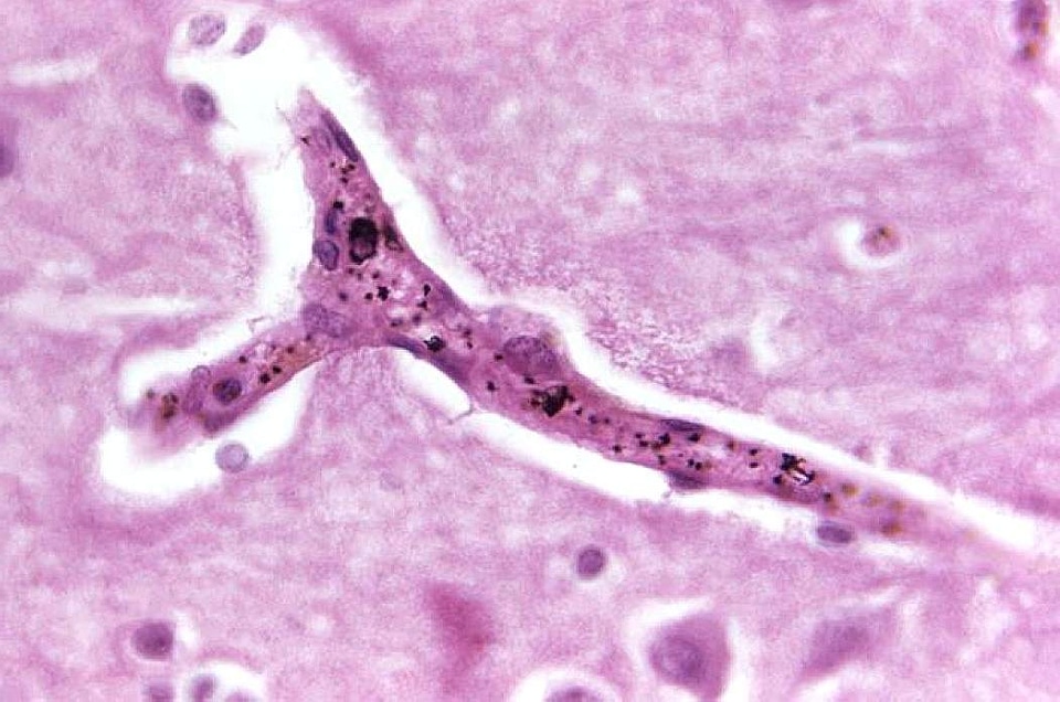 Brain capillary histopathology