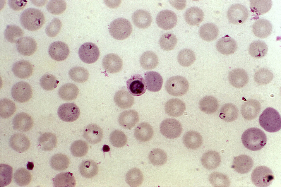 Blood cervical smear 