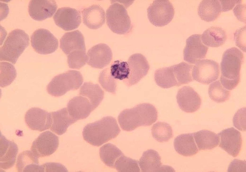 Ancient blood cervical smear