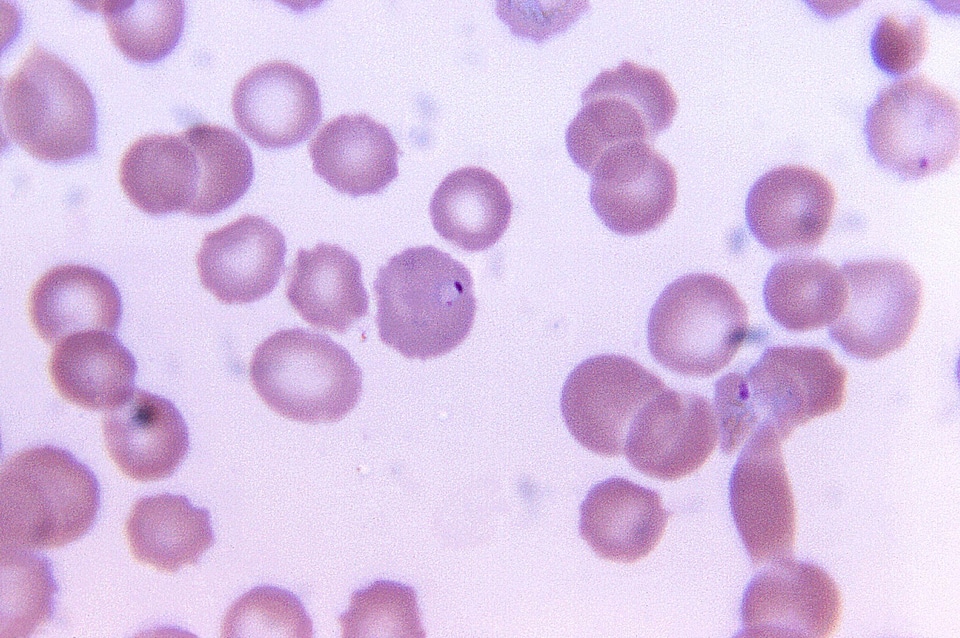 Blood cervical smear reveal