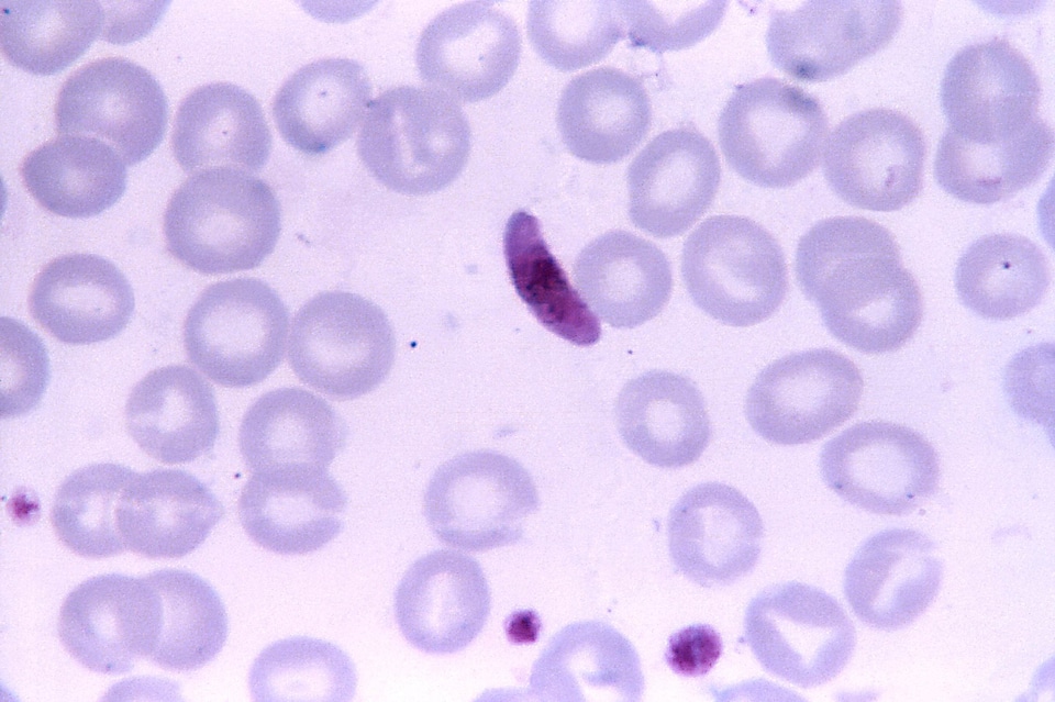 Blood cervical smear parasit
