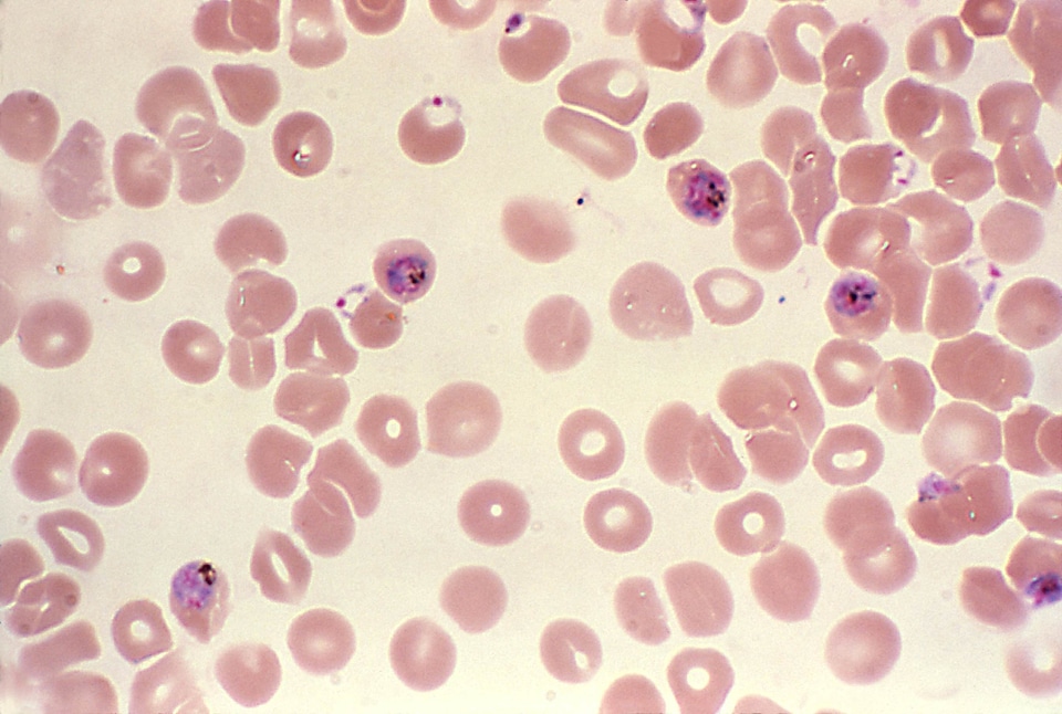 Blood cervical smear dinky