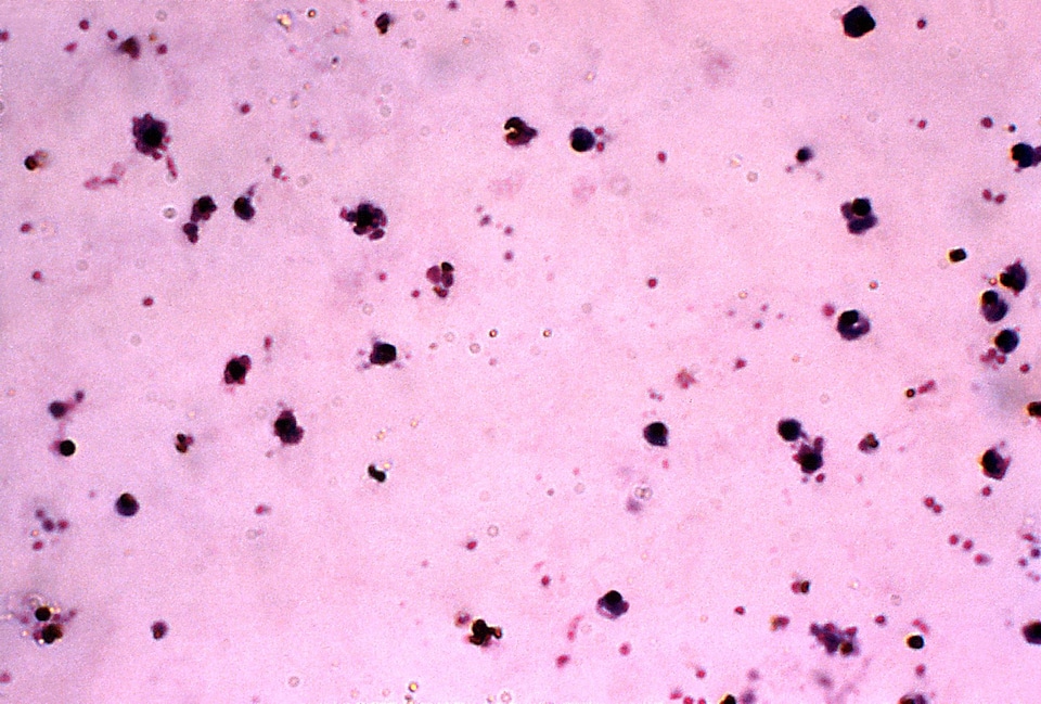Blood cervical smear dinky