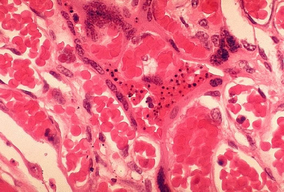 Histopathology malaria placenta