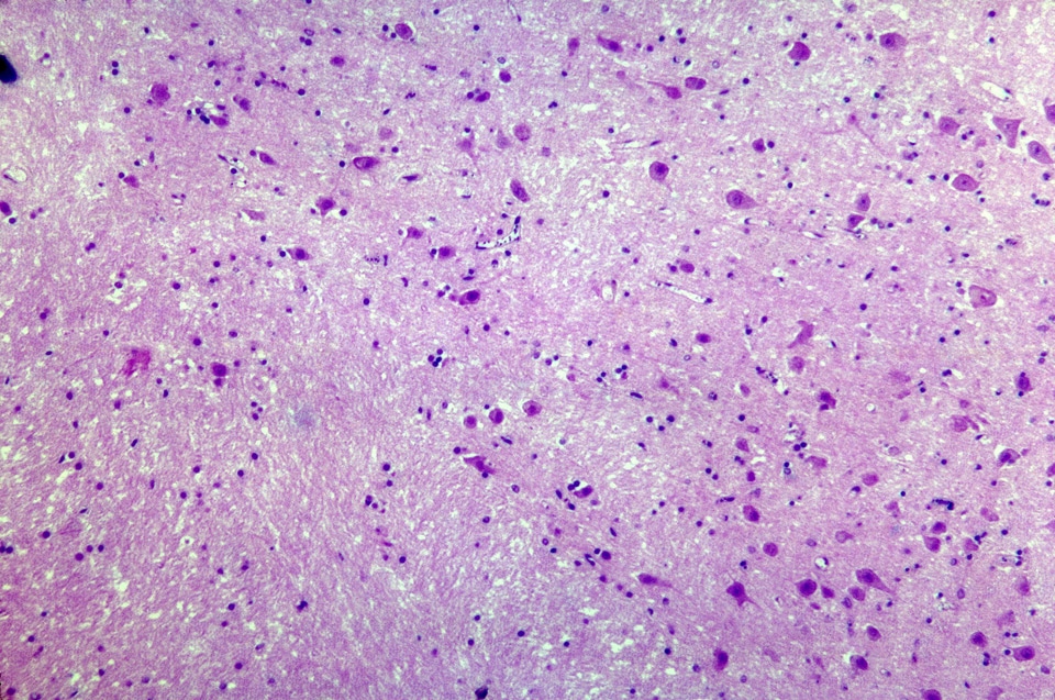 Brain histopathology malaria