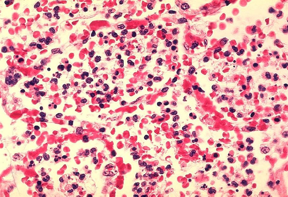 Histopathology human lung