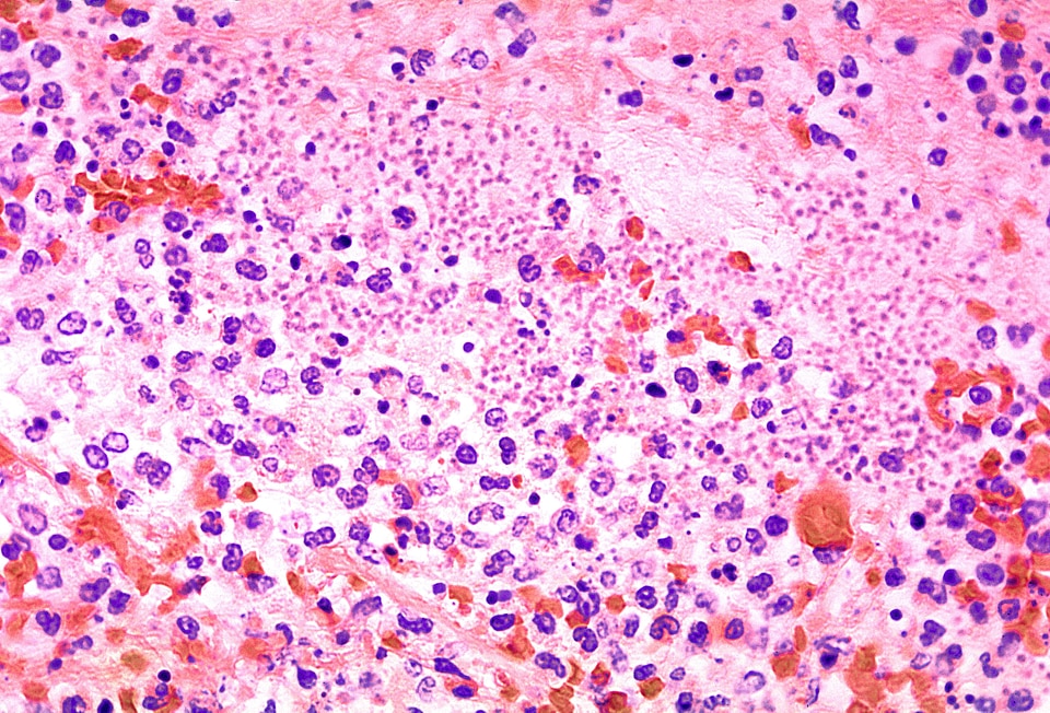 Bacteria many pneumonia
