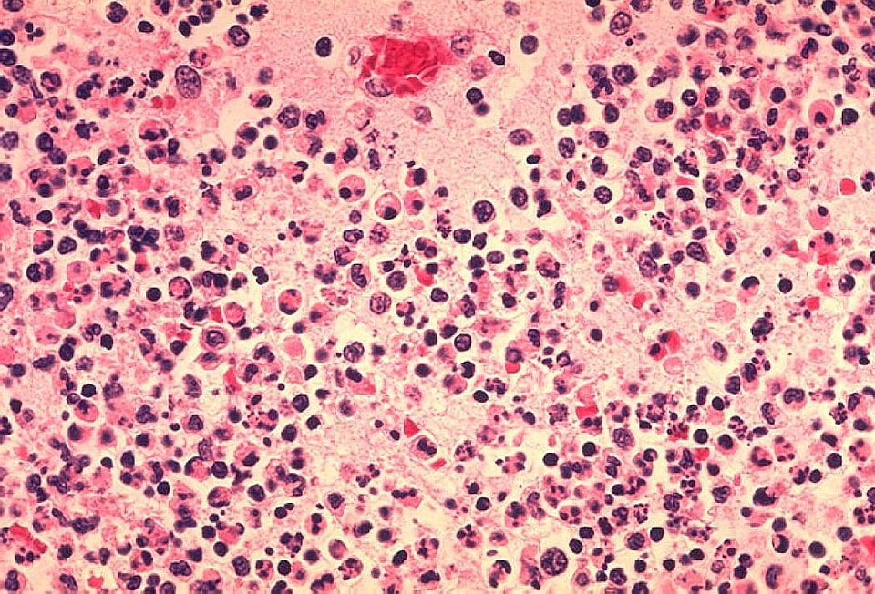 Histopathology human knot