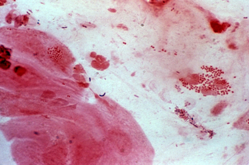 Cervical Smear gram photomicrograph