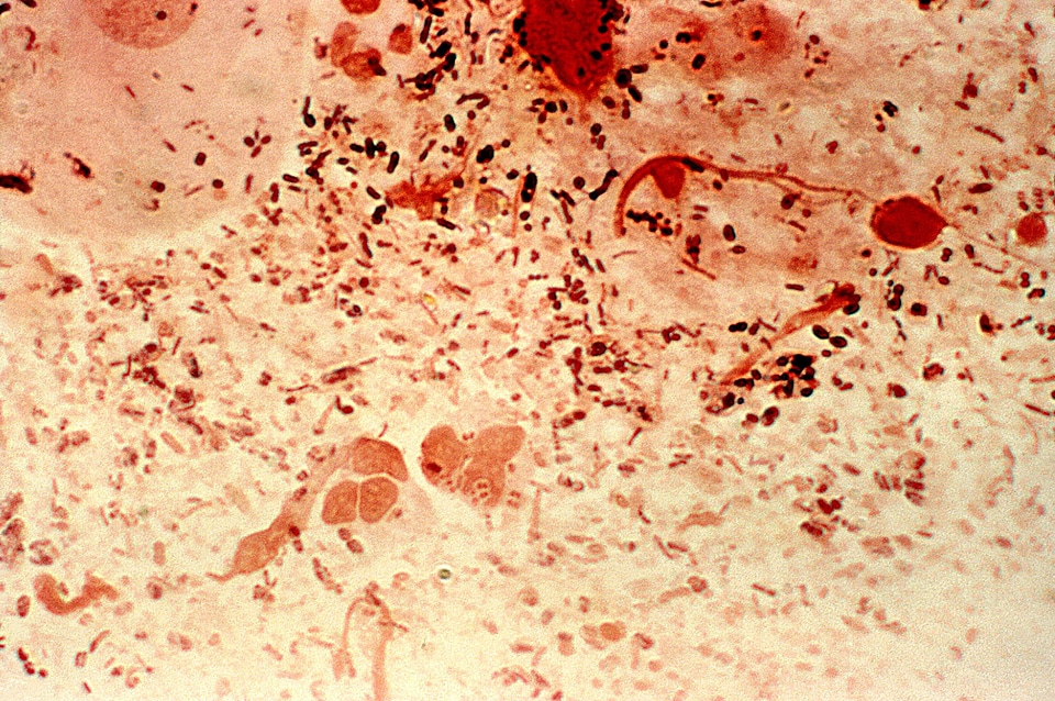 Bacteria gonorrhea gram