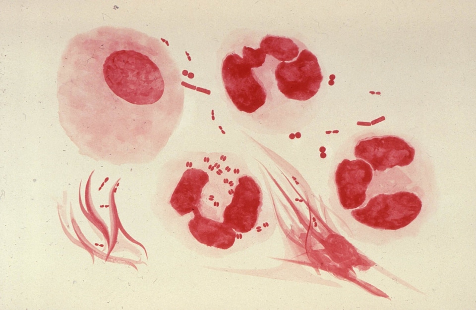 Exudate patient urethritis