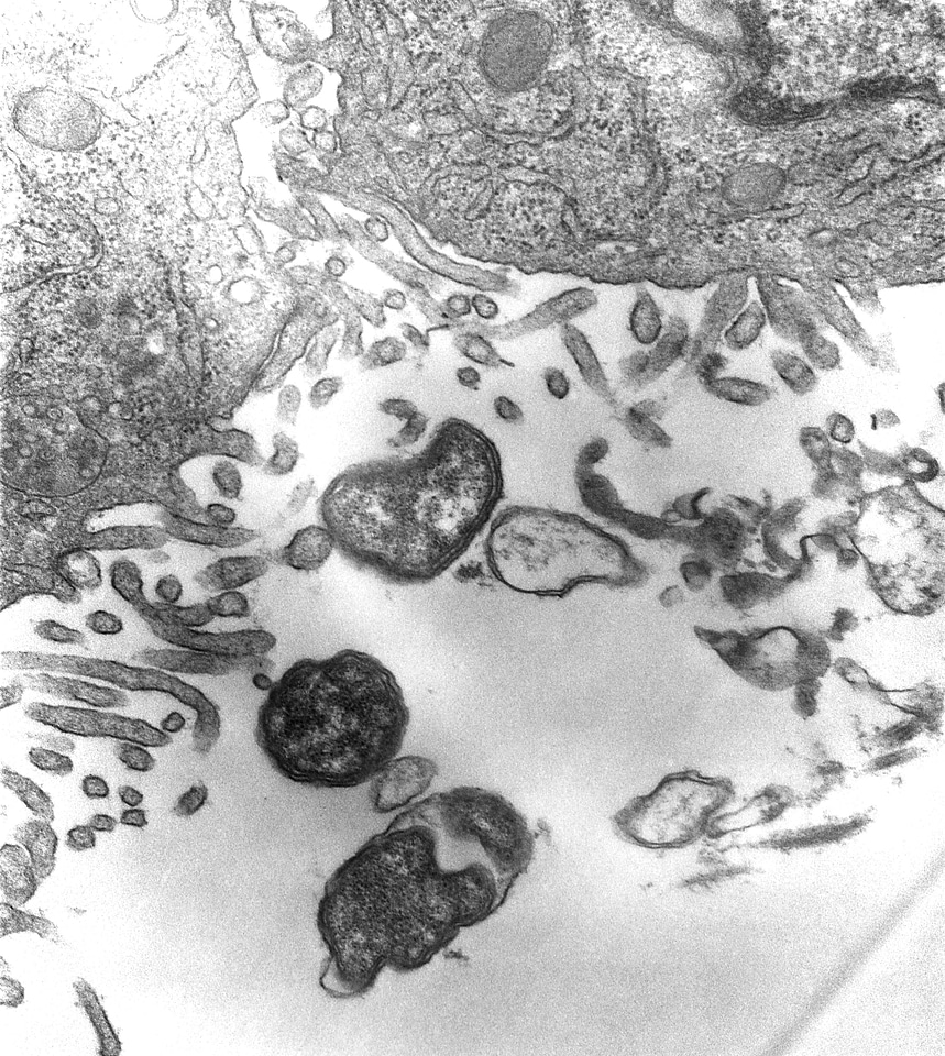 Disease scrub typhus
