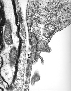 Fever initial lymphadenopathy