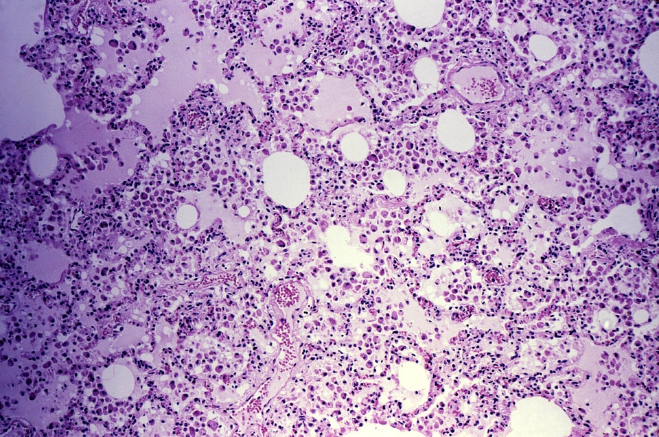 Biopsy lung patient