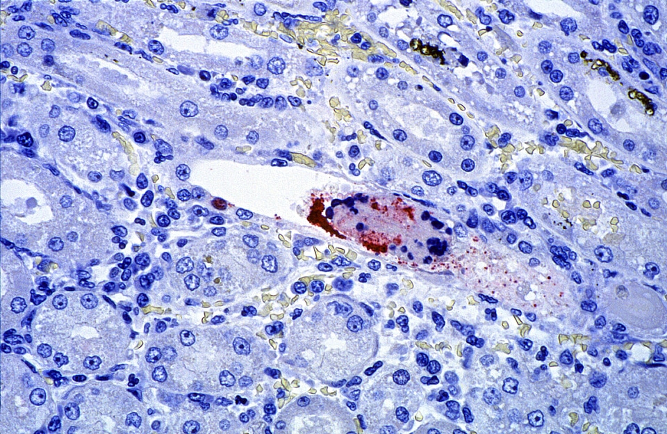 Disease fever nervous system