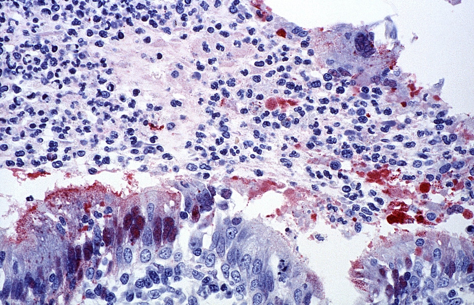 Infection trachea virus