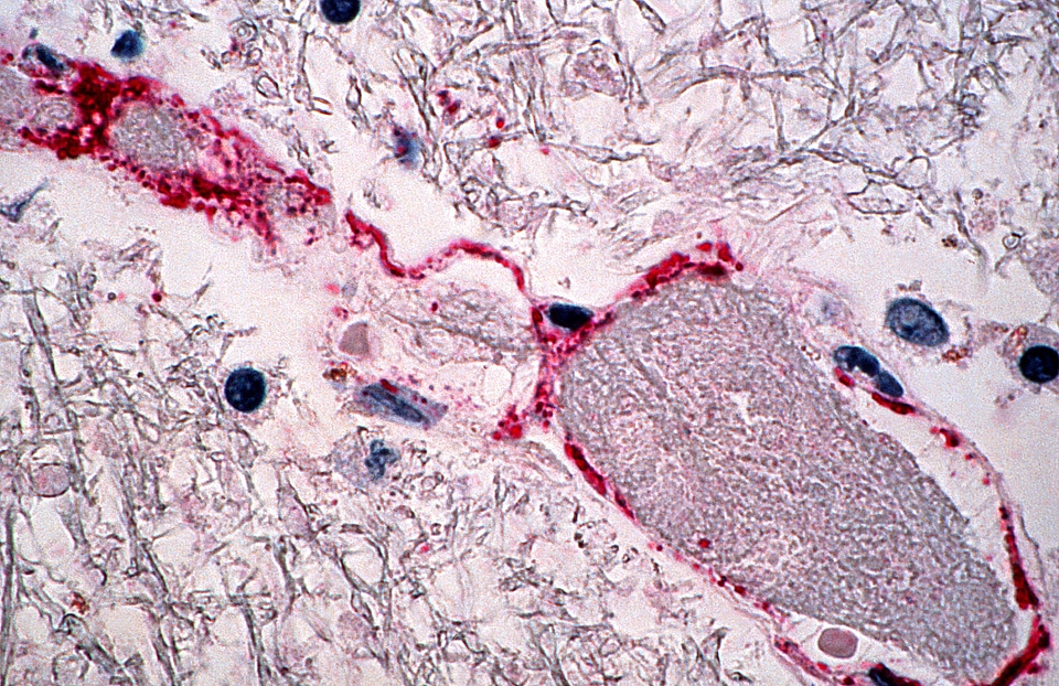 Brain infection inflammation