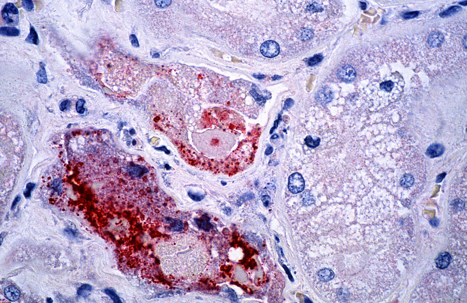 Autumn infection kidney