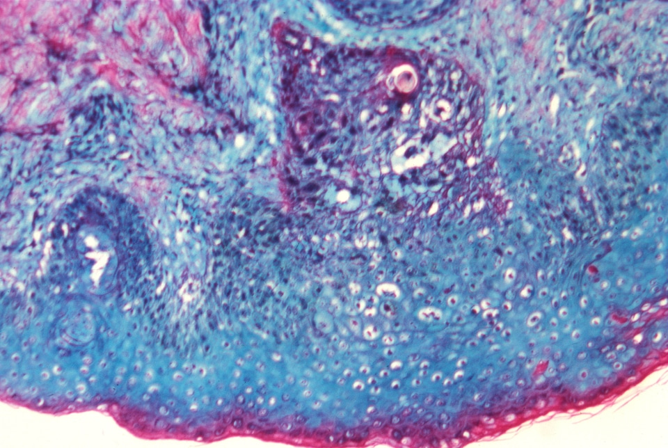 Shovel smallpox variola virus