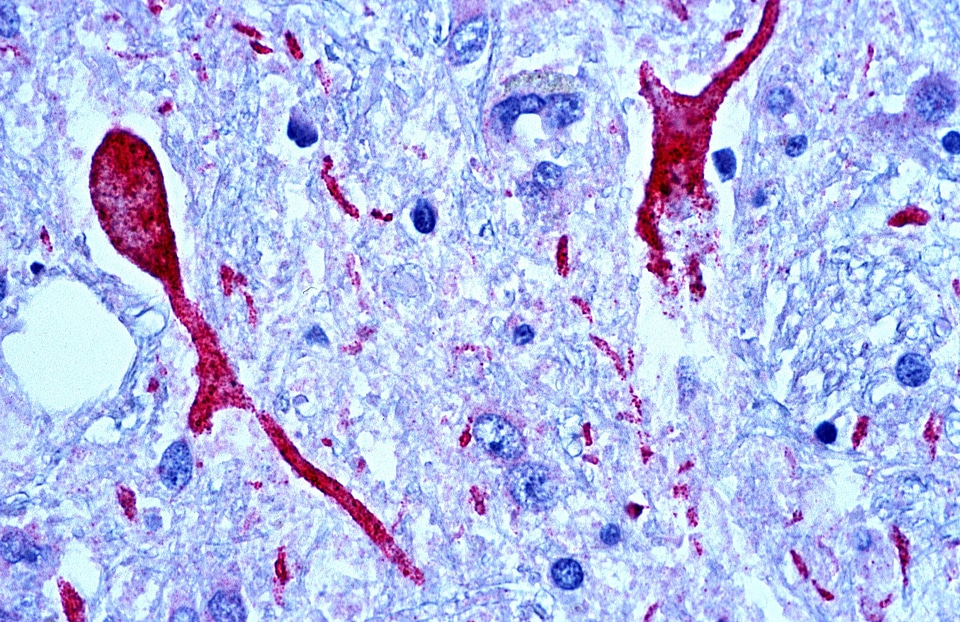 Brain patient tissue