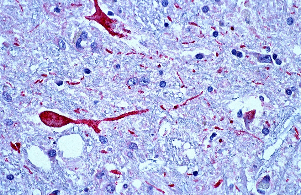Blood brain patient