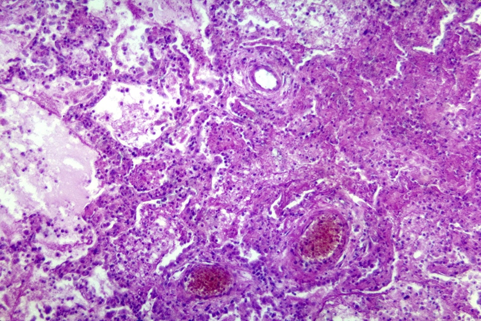 Complication histopathology leukemia