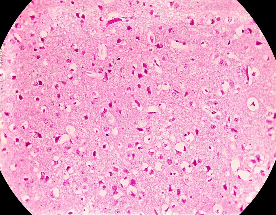 Edema necrosis photomicrograph