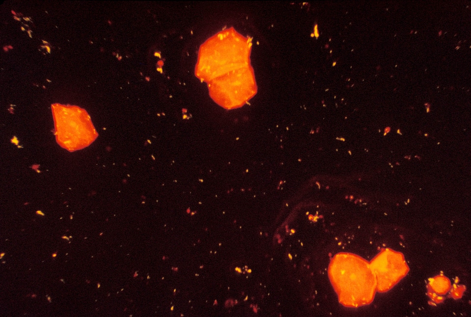 Tuberculosis  