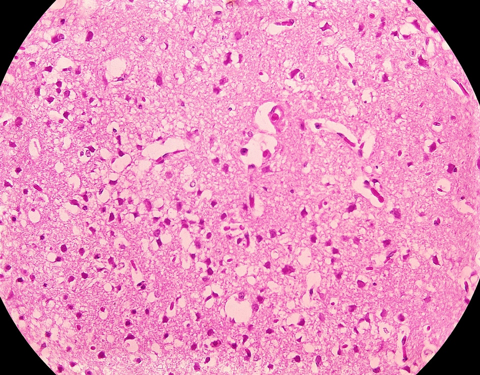 Edema necrosis venezuelan