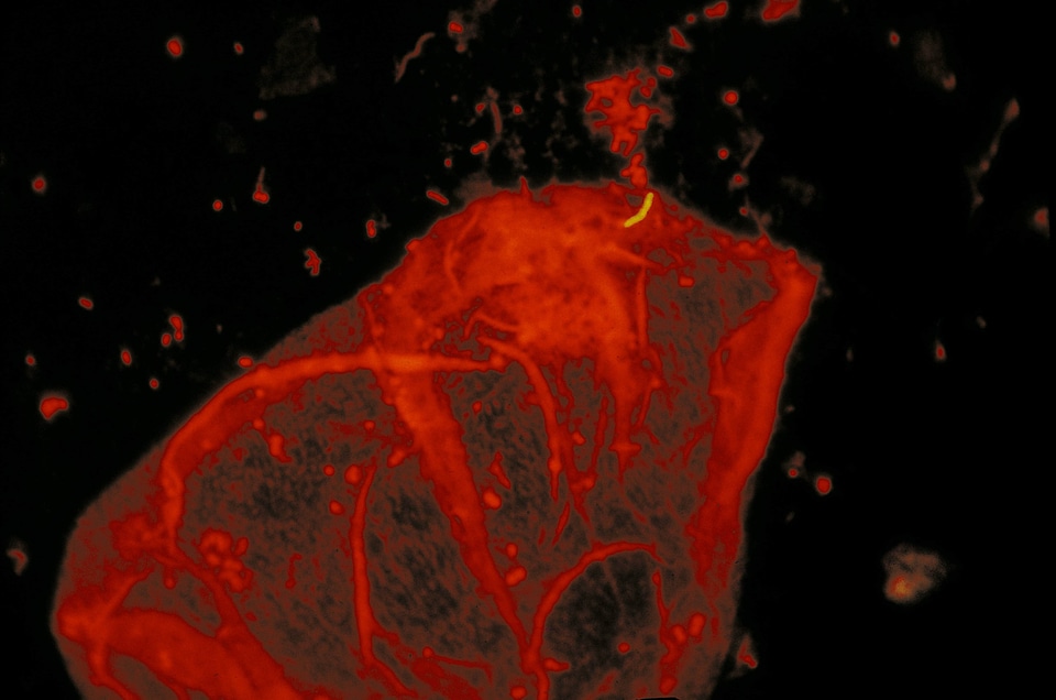 Counterstain orange tuberculosis