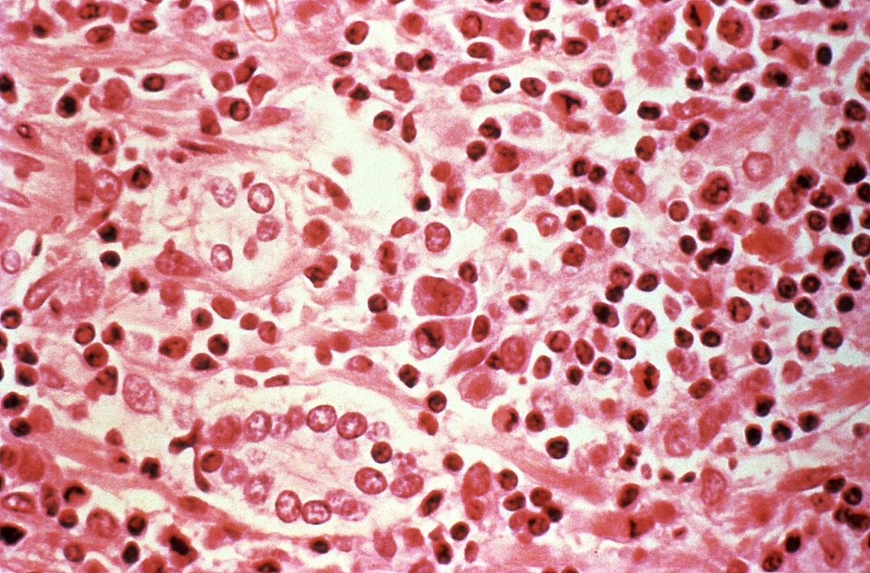 Liver patient study