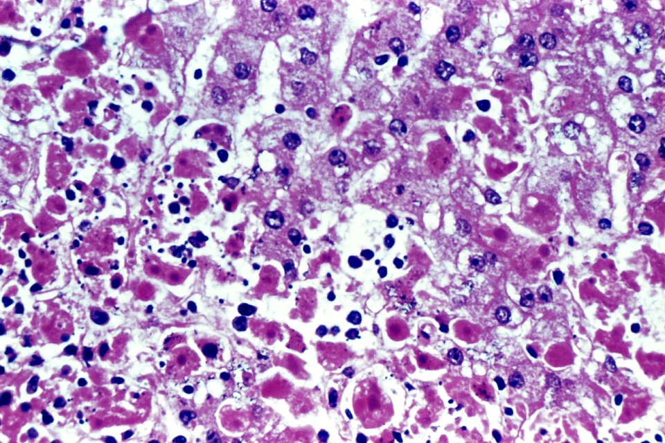 Cause fever hemorrhagic fever