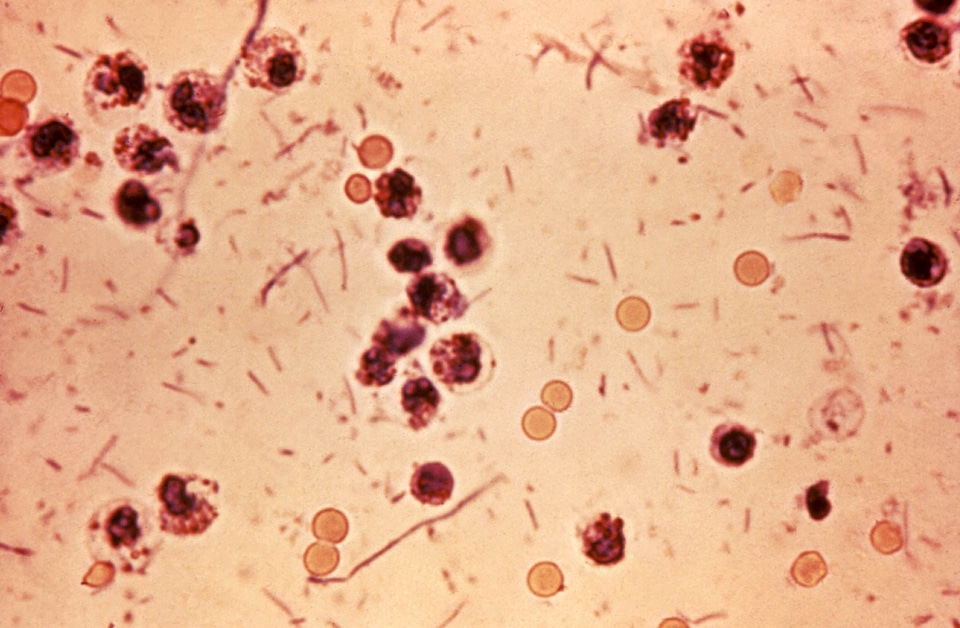 Patient photomicrograph shigella