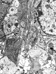 Arbovirus arthropod bite