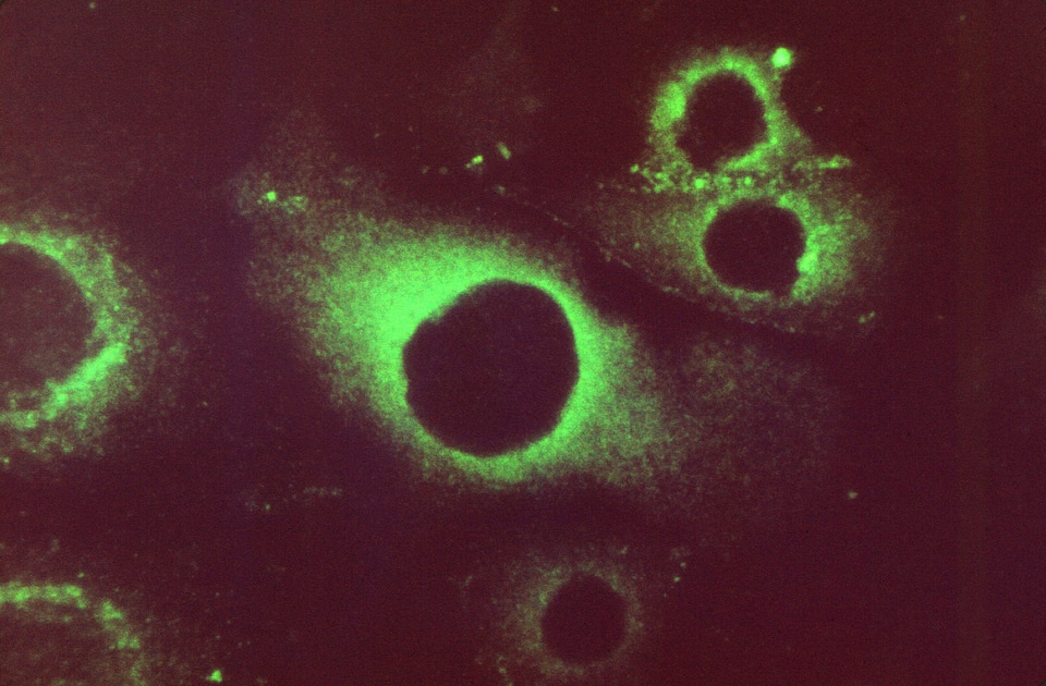 Patient photomicrograph positive