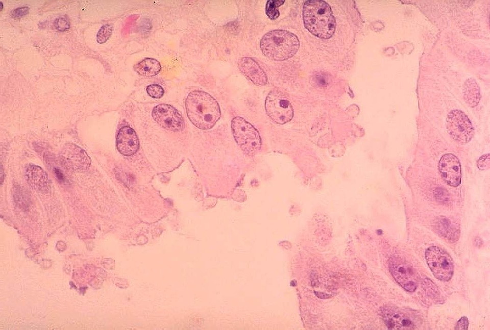 Gallbladder histopathology 