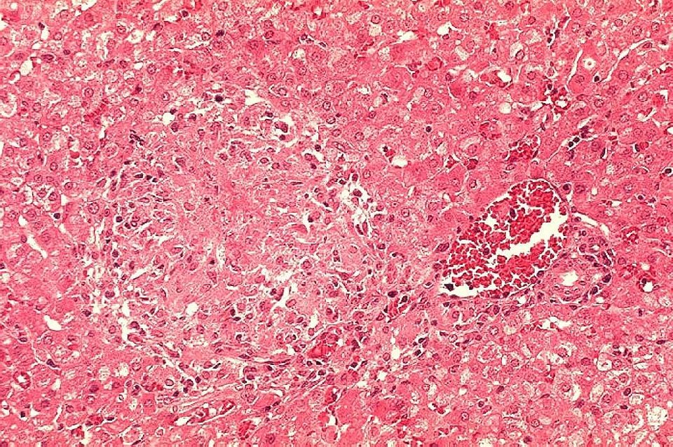 Area granuloma infection