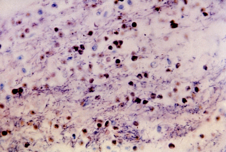 Bacillus bacteria infection