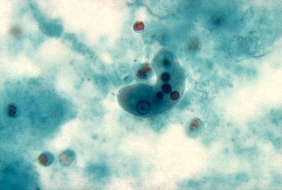 Amebiasis fall lumen