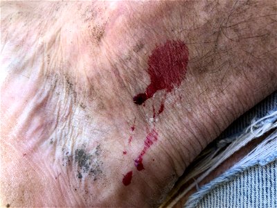 Not Bleeding