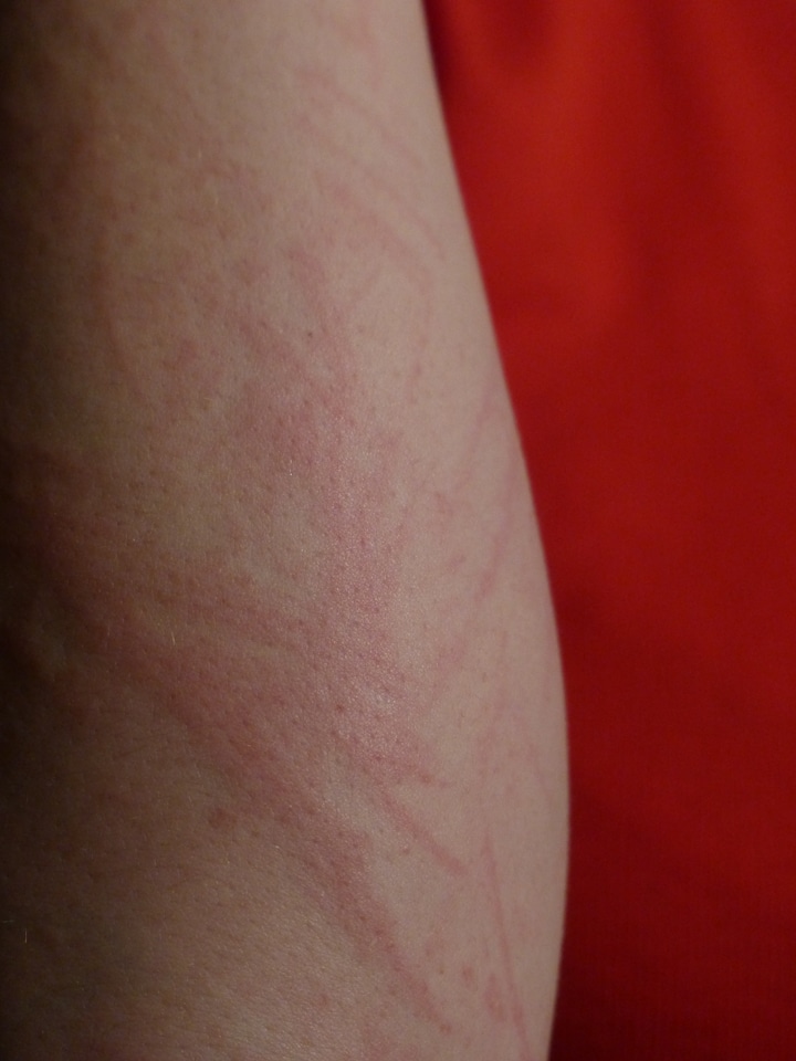 Reddening of the skin rash allergy