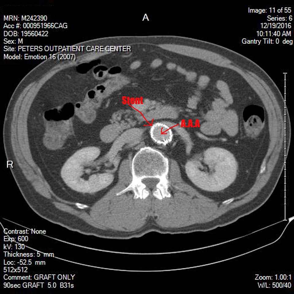 Abdominal aortic aneurysm