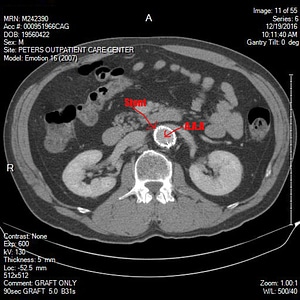 Abdominal aortic aneurysm photo