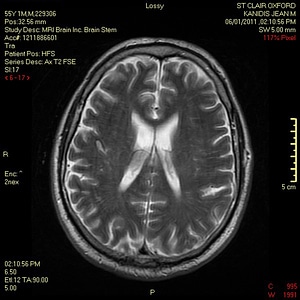 MRI of my Brain photo