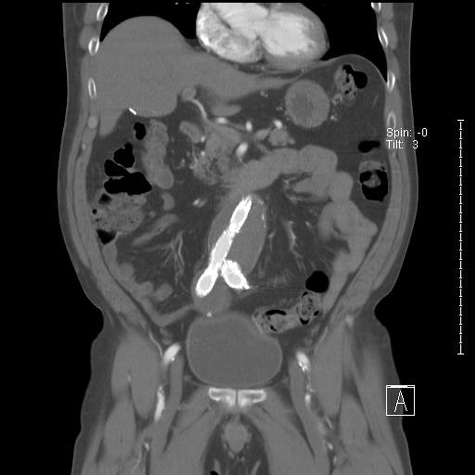 Stent inside abdominal aortic aneurysm