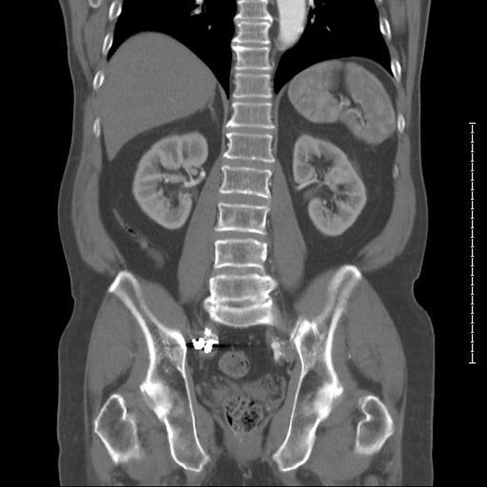 CT showing spine and kidneys photo