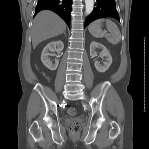 CT showing spine and kidneys photo