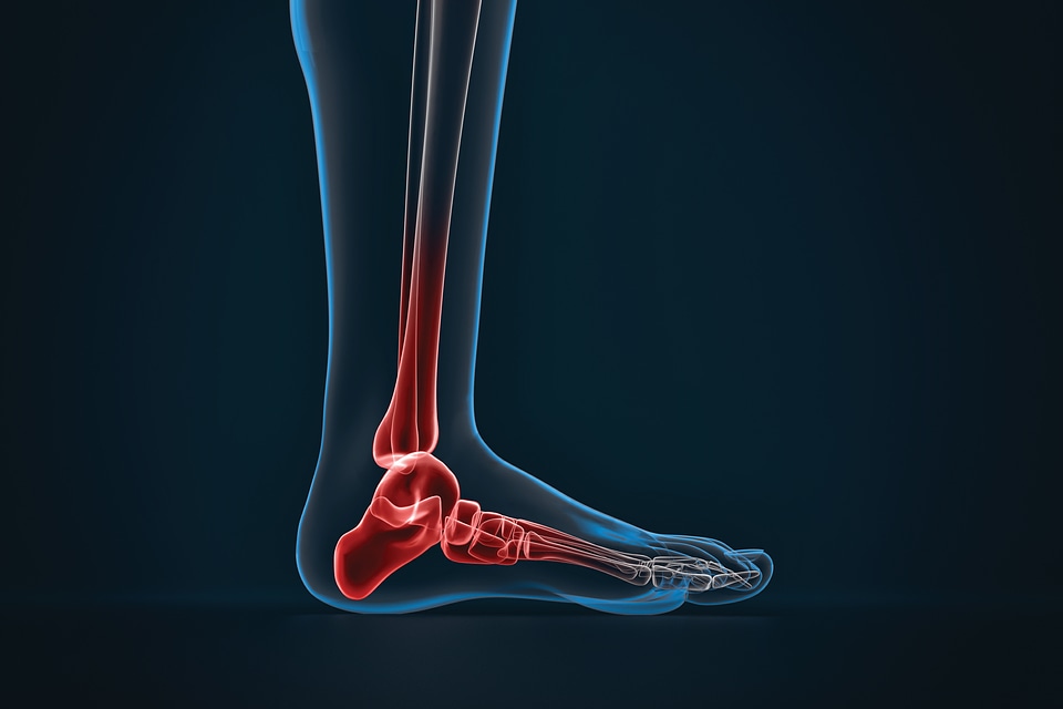 Arthritis of ankle. X-ray of foot. Lateral view photo